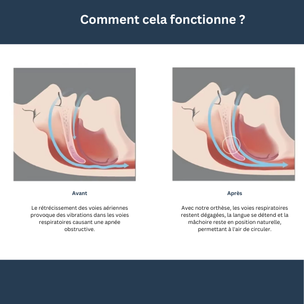 Orthèse contre l’apnée du sommeil